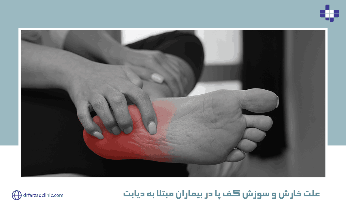 علت خارش و سوزش کف پا